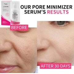 Azelaik Asit Temizleme Losyonu 100g