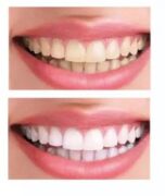 Özel UV Işınlı Diş Beyazlatma Seti